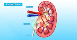 কিডনিতে পাথর হওয়ার কারণ, লক্ষণ ও প্রতিকার